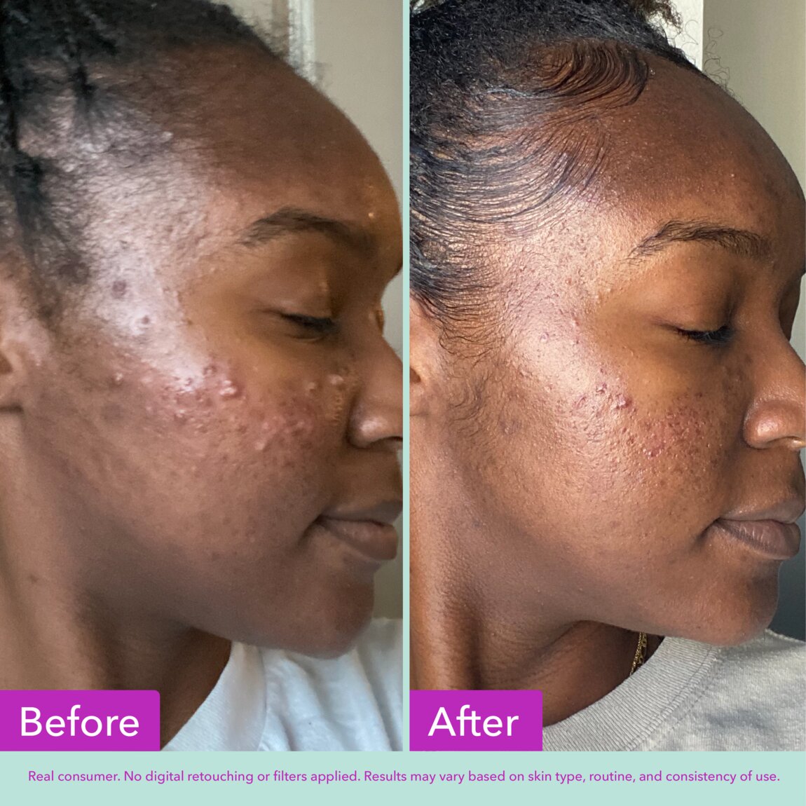 acne-foaming-cleanser-r9 zb_p.jpg